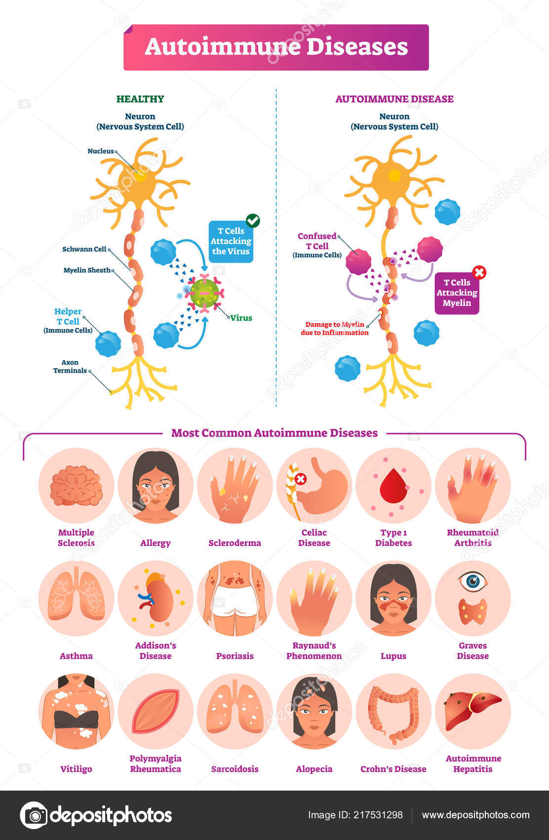 Paleo Diet and autoimmune diseases